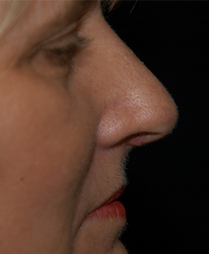 Rhinoplasty1b